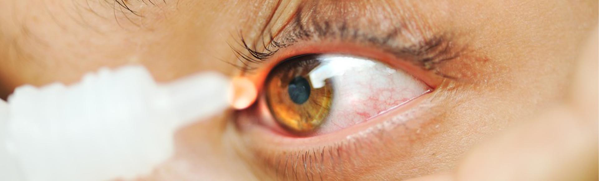 Синдром «сухого глаза». Симптомы, диагностика и лечение