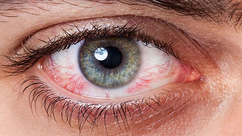 Синдром «сухого глаза». Симптомы, диагностика и лечение